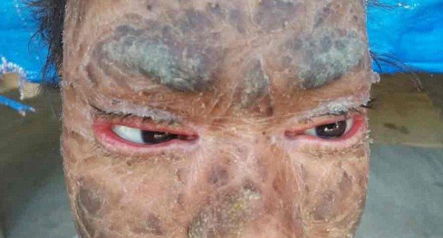 Девочка-змея сбрасывает кожу каждые полтора месяца