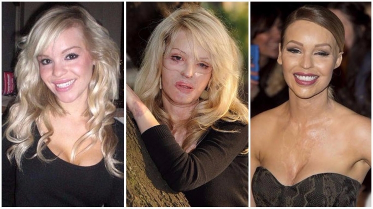 Реальные истории изуродованных девушек, которых облили кислотой Реальные истории изуродованных девушек, которых облили кислотой