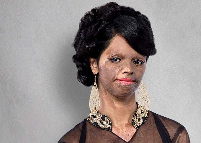 Реальные истории изуродованных девушек, которых облили кислотой Реальные истории изуродованных девушек, которых облили кислотой