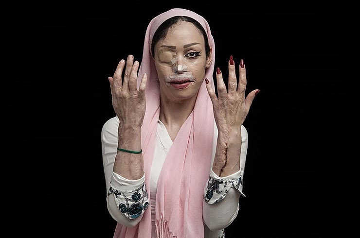 Реальные истории изуродованных девушек, которых облили кислотой Реальные истории изуродованных девушек, которых облили кислотой