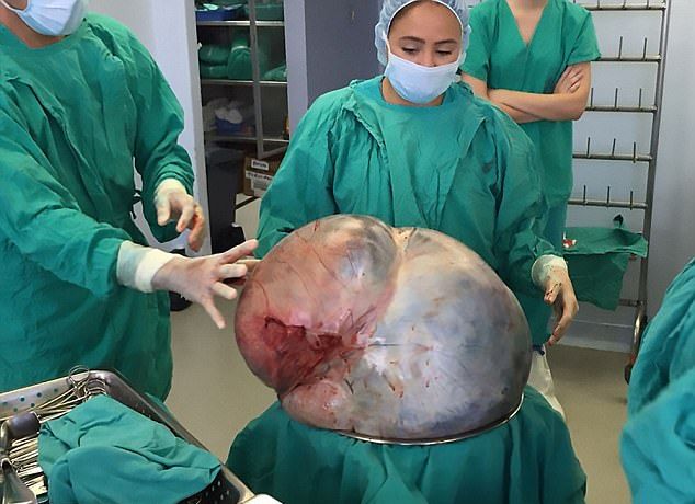 Из пожилой женщины вырезали опухоль весом 32 кг, которую она вынашивала восемь лет