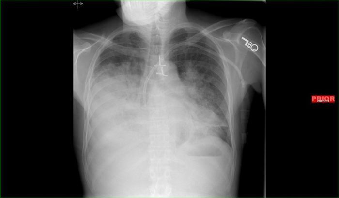 Осложнения после гриппа (8 фото)