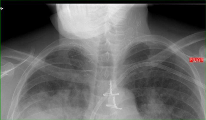 Осложнения после гриппа