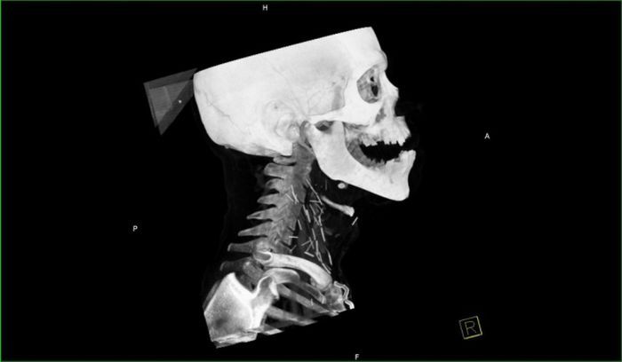 Осложнения после гриппа