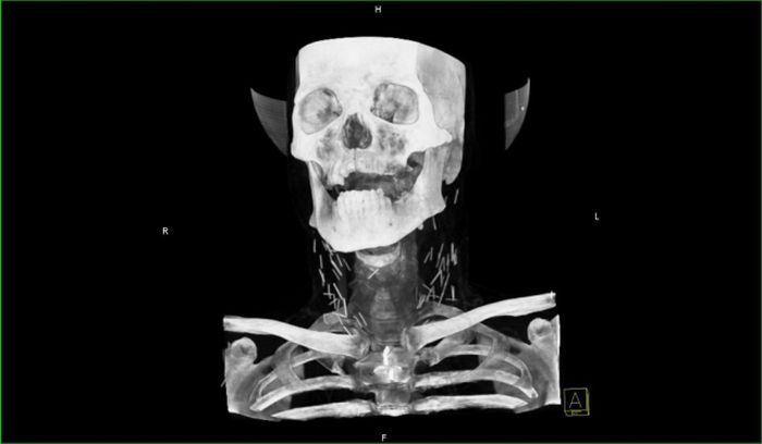 Осложнения после гриппа
