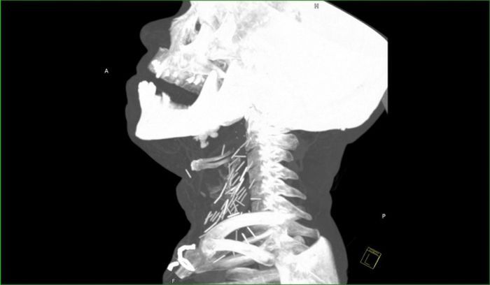 Осложнения после гриппа