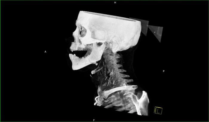 Осложнения после гриппа