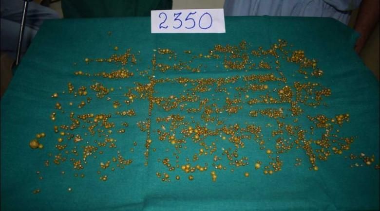 2350 камней извлекли хирурги из желчного пузыря 50-летней женщины