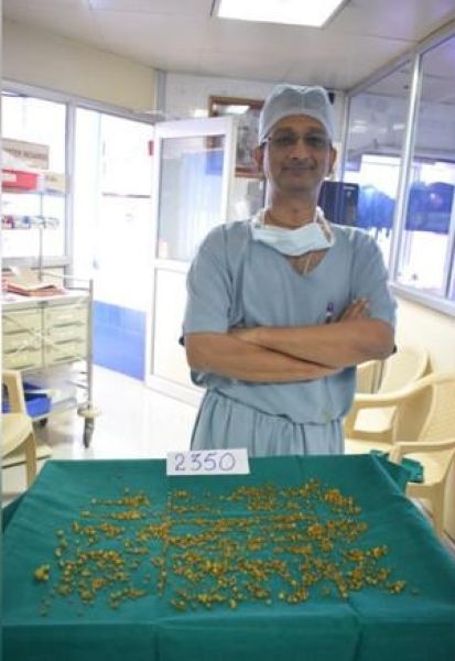 2350 камней извлекли хирурги из желчного пузыря 50-летней женщины