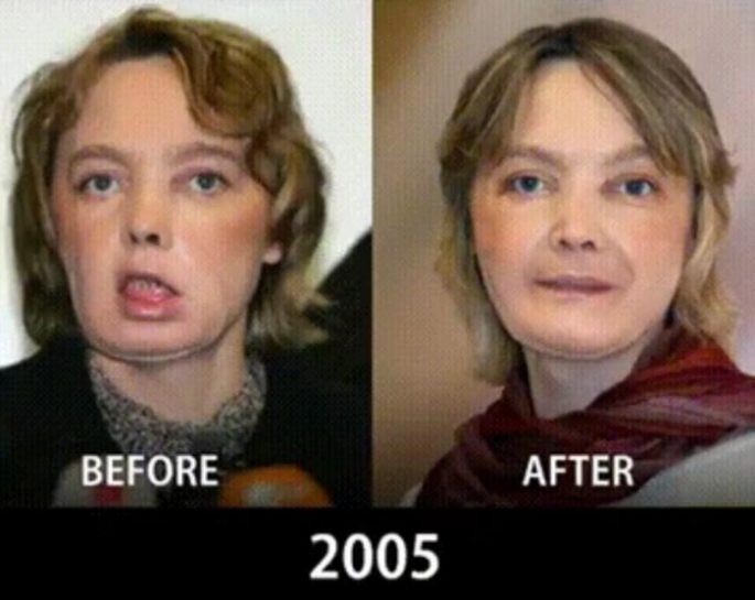Сравнительные фотографии, показывающие как операции по пересадке лица продвинулись за 10 лет