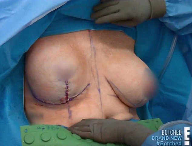 Женщина с неудачными имплантами вынуждена была крепить грудь скотчем
