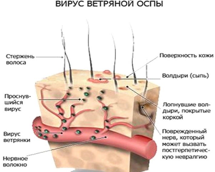 Детские заболевания, которые плохо переносят взрослые Детские заболевания, которые плохо переносят взрослые