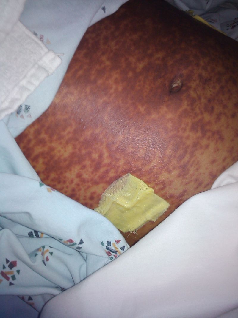 Человек, перенесший синдром Лайелла, проходит через все круги ада
