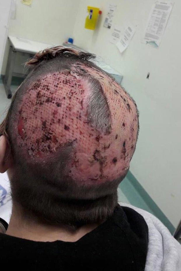 Девушка осталась практически лысой, пытаясь сделать себе волосы в стиле 'единорога'