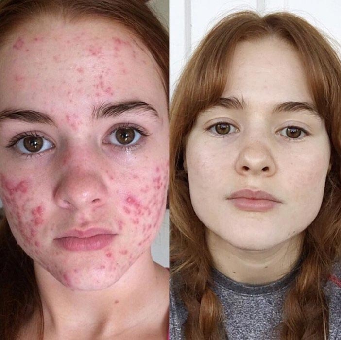 До и после акне: 5 реальных историй девушек, которые смогли победить прыщи До и после акне: 5 реальных историй девушек, которые смогли победить прыщи