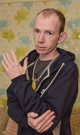 Парень проснулся с бодуна и увидел, что у него пропала часть пальца
