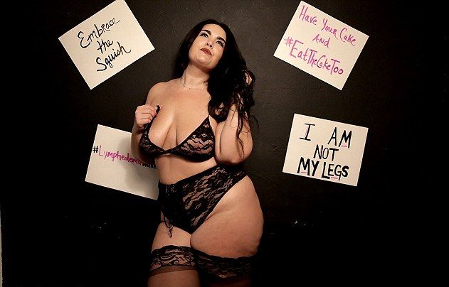 30-летняя женщина с большими отечными ногами стала сенсацией Instagram, начав позировать в сексуальном нижнем белье