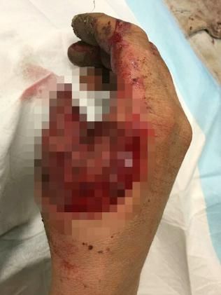 Пареньку пересадили большой палец ноги на руку вместо оторванного быком