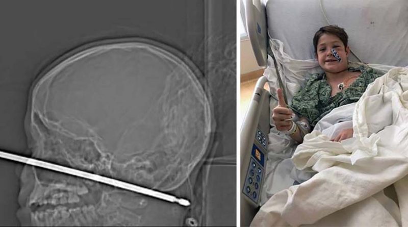 Мальчик проткнул голову шампуром и выжил Мальчик проткнул голову шампуром и выжил