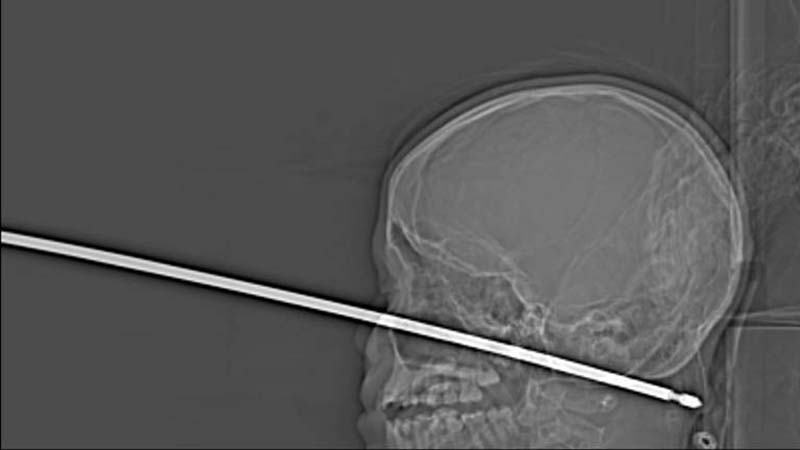 Мальчик проткнул голову шампуром и выжил Мальчик проткнул голову шампуром и выжил