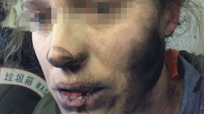 У пассажирки самолета взорвались наушники