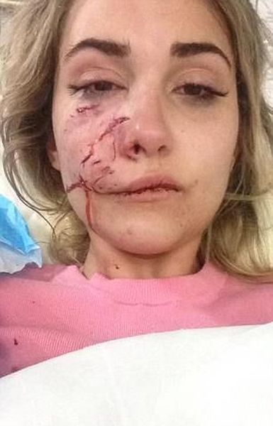 Питбуль так изуродовал лицо модели, что не помогла даже пластическая операция