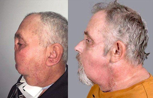 64-летний дедуля стал самым старым человеком в мире, которому пересадили новое лицо