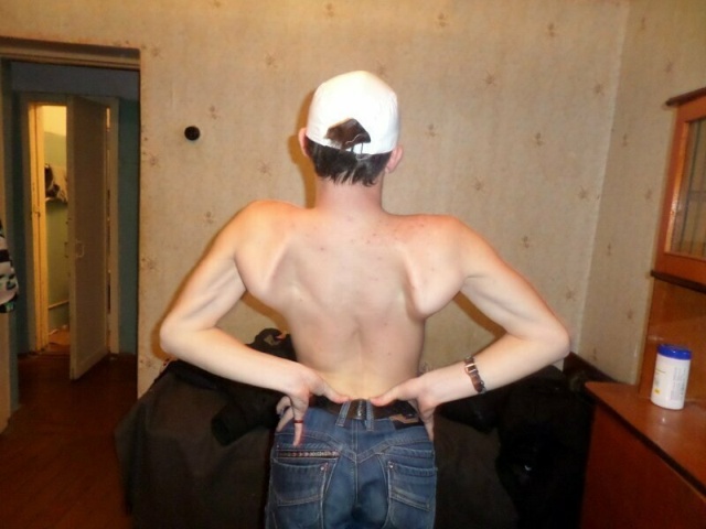 Синдром широкой спины или "жертвы качалки" Синдром широкой спины или "жертвы качалки"