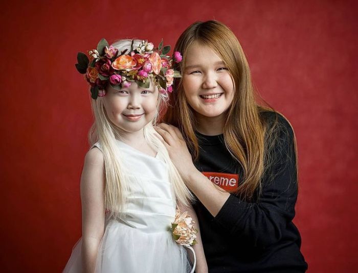 8-летняя девочка-альбинос Нарияна, которую зовут «Снежной королевой»