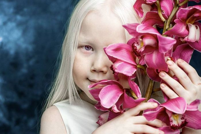 8-летняя девочка-альбинос Нарияна, которую зовут «Снежной королевой»