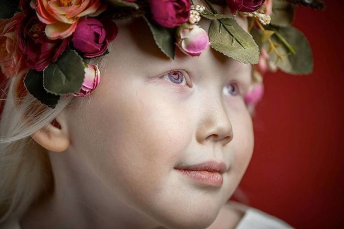 8-летняя девочка-альбинос Нарияна, которую зовут «Снежной королевой»