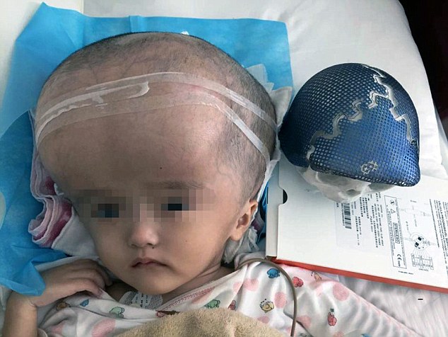 3-летней девочке в Китае пересадили череп, напечатанный на 3D-принтере 3-летней девочке в Китае пересадили череп, напечатанный на 3D-принтере