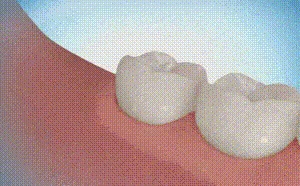 Удаление зуба мудрости