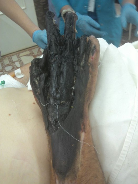 Случаи из практики врача-комбустиолога