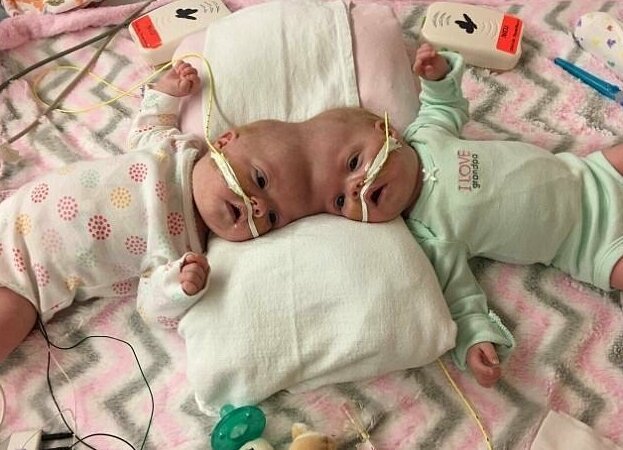 Право на жизнь: 1,5-годовалые сиамские близнецы, родившиеся со сращенными головами, восстановились после сложнейшей операции и радуются каждому дню