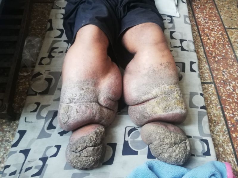 Из-за укуса комара у 38-летнего мужика огромные каменные ноги