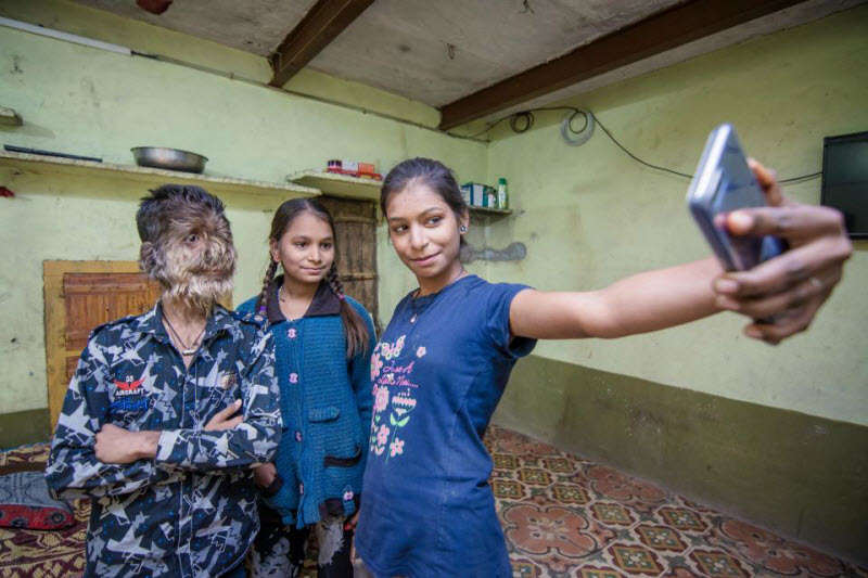 Индийский оборотень: лицо 13-летнего мальчика покрыто волосами