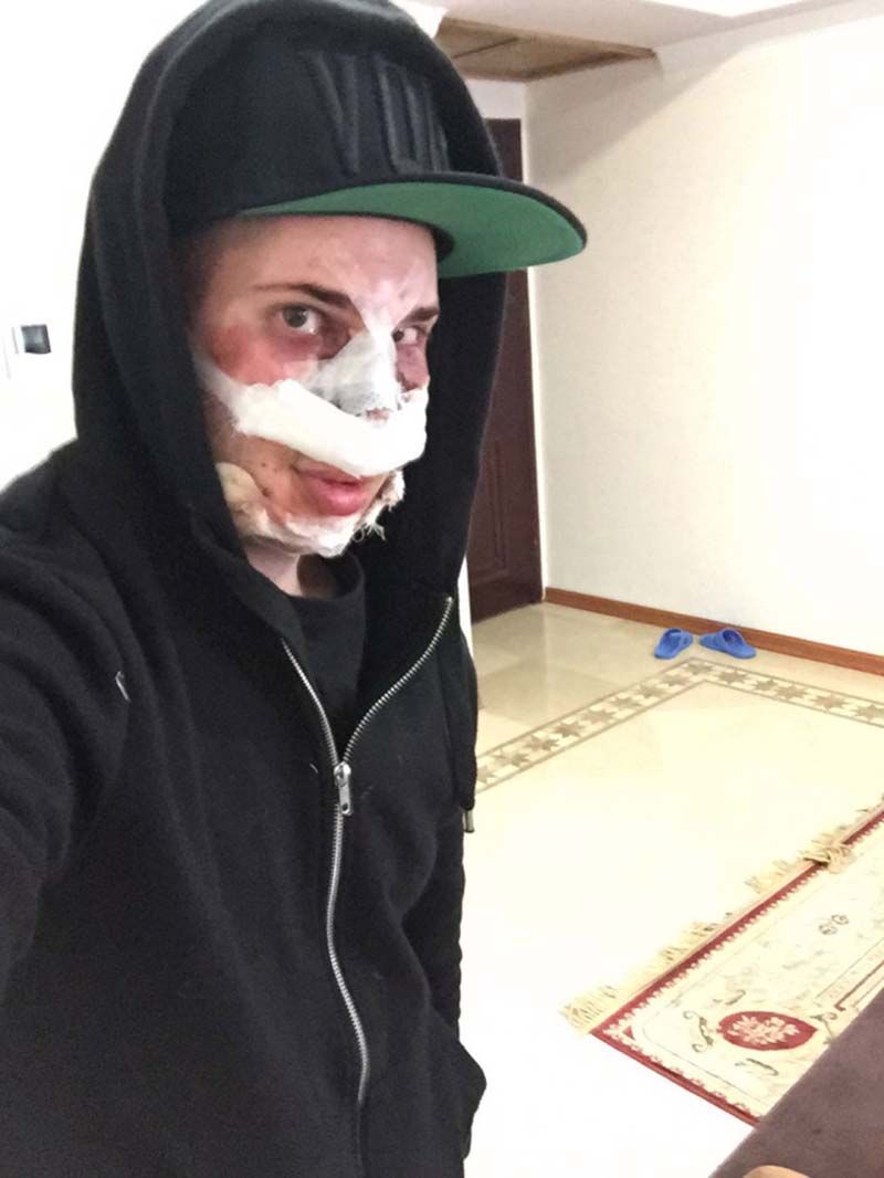 Австралиец так перекроил свое лицо, что его не узнал бывший парень