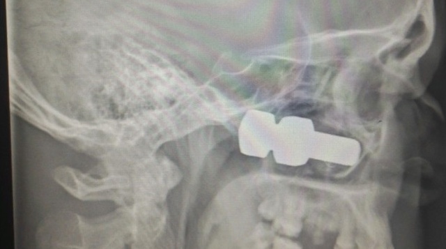 Из-под колеса грузовика вылетел болт, который попал в голову лесосибирцу