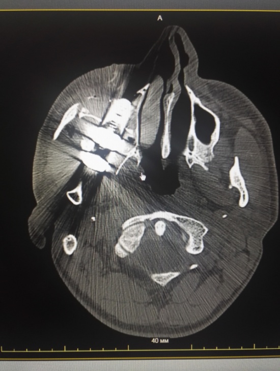 Из-под колеса грузовика вылетел болт, который попал в голову лесосибирцу