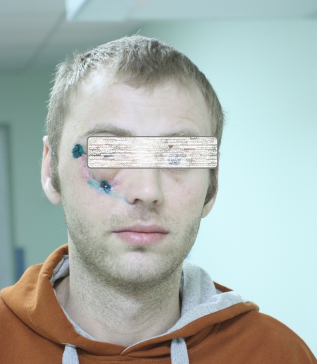 Из-под колеса грузовика вылетел болт, который попал в голову лесосибирцу