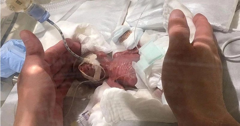 В Токио медики выходили самого недоношенного ребенка в мире