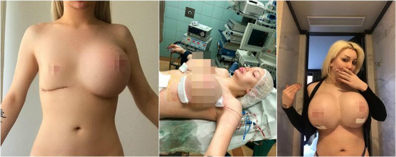 Трансгендерная женщина вынуждена была год жить с одной грудью и получила прозвище «Циклоп»
