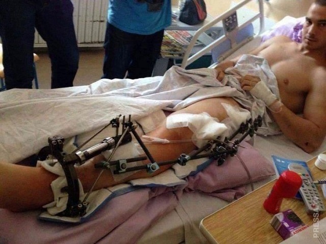 Безотходное производство. Байкер сделал нож из своей бедренной кости