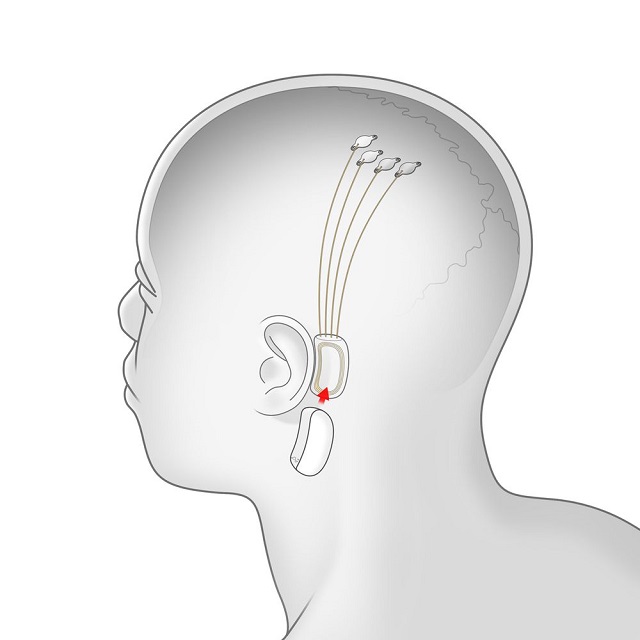 Стартап Илона Маска Neuralink представил новый нейротехнологический проект