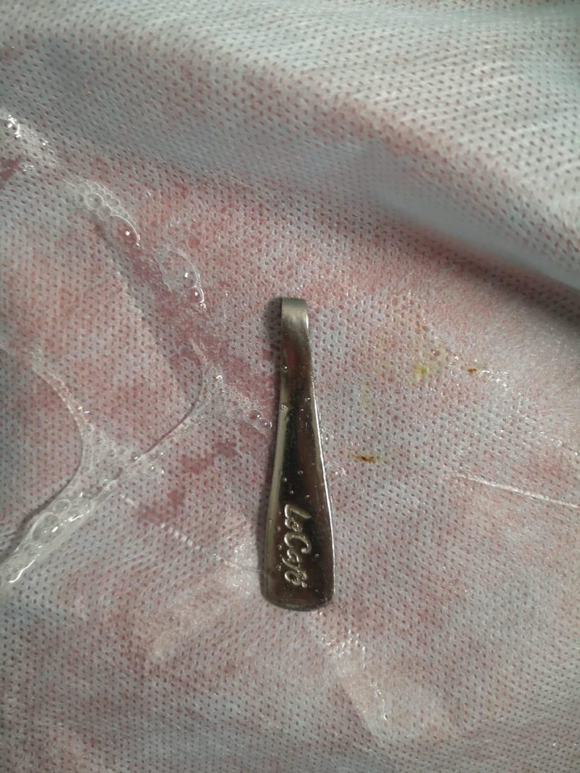 Россиянин пожаловался врачам на ложку в своем теле