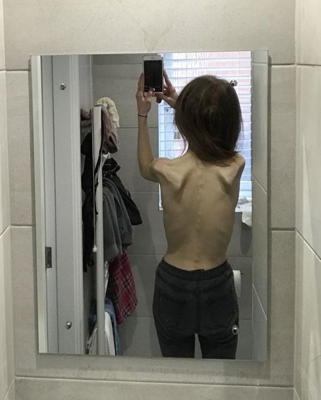 Британка чуть не умерла от анорексии, но за полгода она смогла победить болезнь Британка чуть не умерла от анорексии, но за полгода она смогла победить болезнь