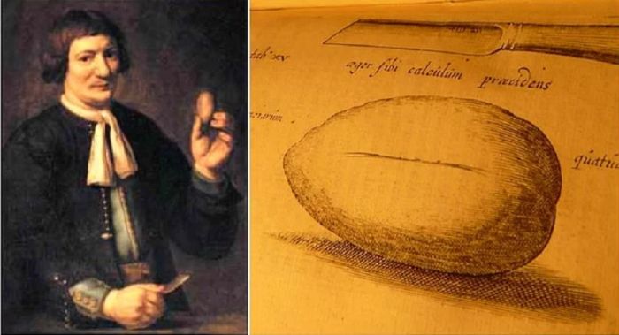 Как кузнец себе литотомию сделал