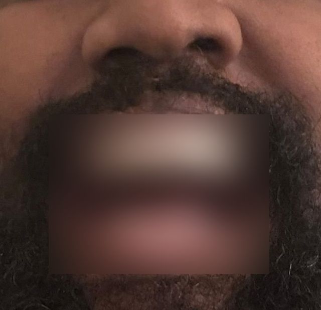 “Улыбка из титана”: Канье Уэст заменил все свои зубы на протез