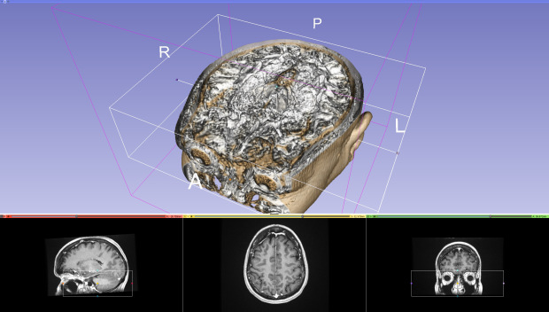 Мужчина спас зрение жены благодаря 3D печати Мужчина спас зрение жены благодаря 3D печати